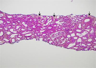 Case Report: Let Us Not Forget the Treatment That Some Patients Have Received—The Brief 50-Year History of a Kidney Transplant Survivor